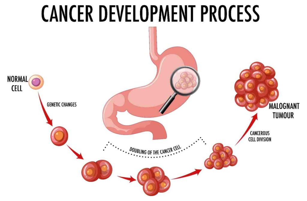 How I Know I had stomach Cancer