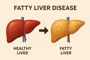 Read more about the article What are the Symptoms of fatty liver disease